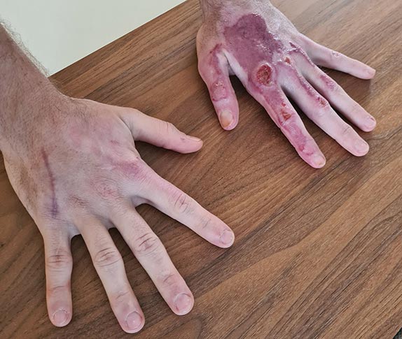 Руки Романа Грожана. Фото из Instagram гонщика